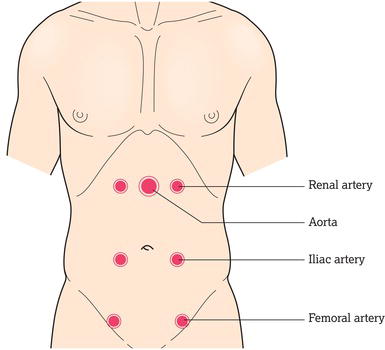 Stethoscope positioning for auscultating bruits.