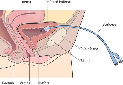 Suprapubic catheter. Source: Reproduced with permission of Shutterstock.com.