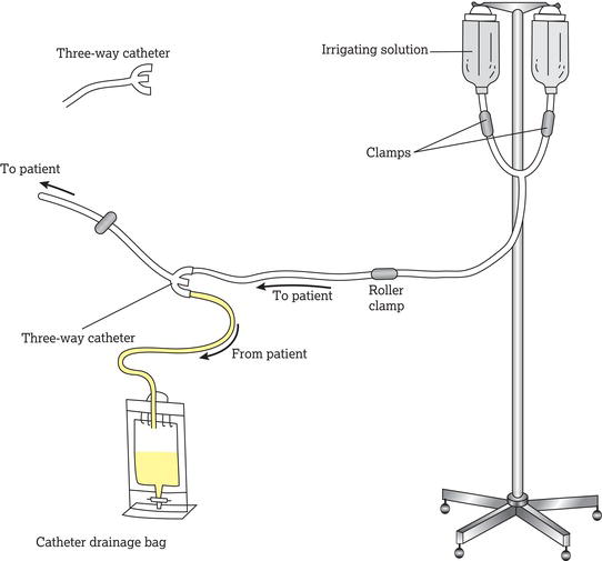 Closed urinary drainage system with provision for intermittent or continuous irrigation.