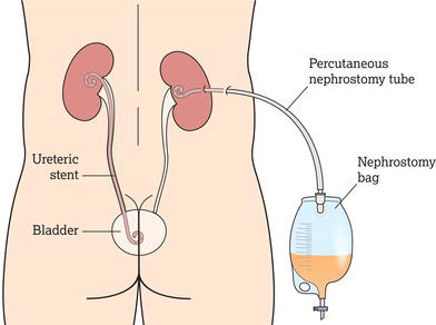 Nephrostomy bag.