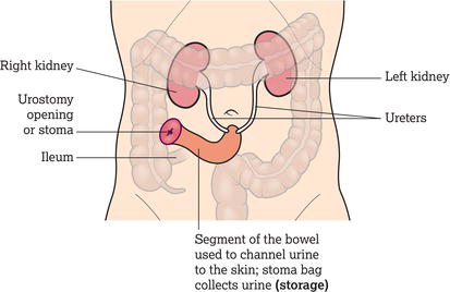 Ileal conduit.