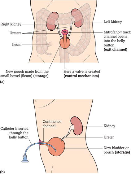 A Mitrofanoff urinary diversion. (a) Front view. (b) Side view with a catheter in situ.