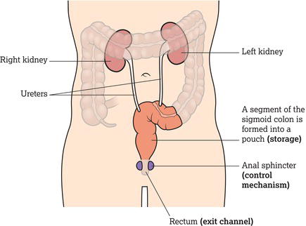 A Mainz II urinary diversion.