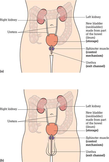 (a) Female orthotopic neobladder. (b) Male orthotopic neobladder.