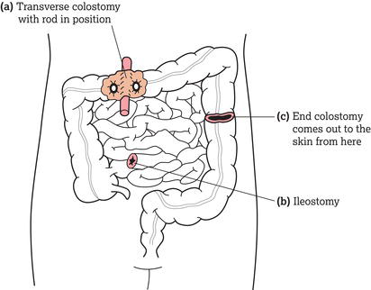 (a) Transverse (loop) colostomy, (b) ileostomy and (c) end colostomy.