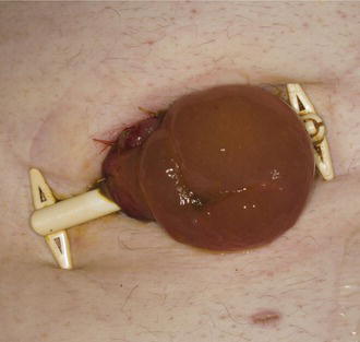 Loop colostomy with bridge in situ.