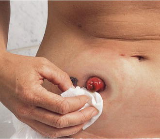 End ileostomy illustrating the ‘spout’. Source: Reproduced with permission of Dansac Ltd.