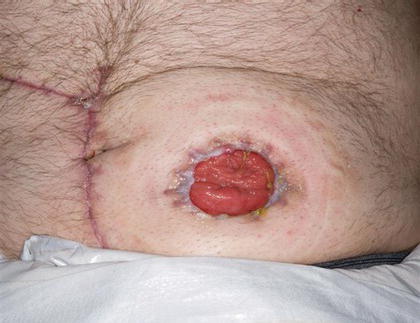 A newly formed Carter double‐barrelled wet colostomy.