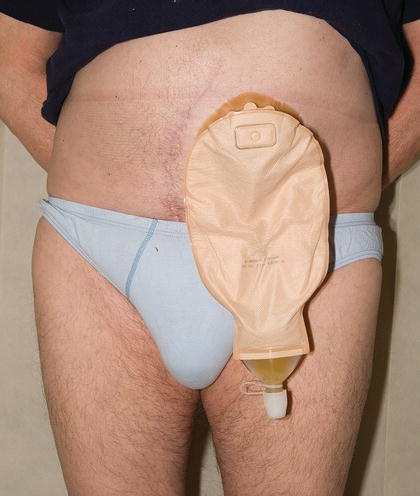 A patient wearing a specialist stoma product for the Carter stoma.