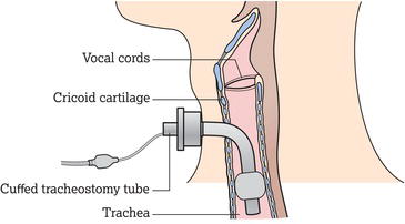 A tracheostomy tube in situ. Source: Reproduced from Munir and Clarke (). © 2013 Nazia Munir and Ray Clarke. Published 2013 by Blackwell Publishing Lt