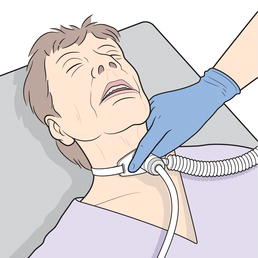 A patient with an artificial airway.