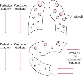 The effect of gravity on the distribution of ventilation and perfusion in the lung in the upright and lateral positions. Source: Reproduced from Hough