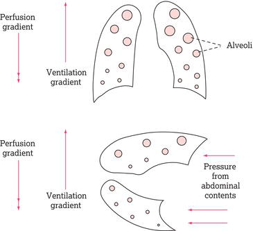 The effect of controlled mandatory ventilation on ventilation and perfusion gradients. In contrast to spontaneous respiration, the perfusion gradient 