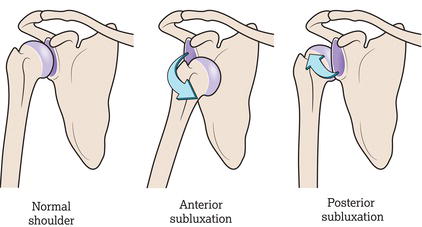 Shoulder subluxation.