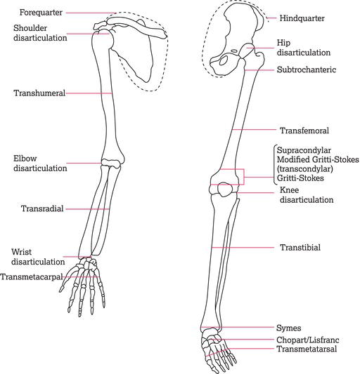 Levels of amputation in the upper and lower limbs.