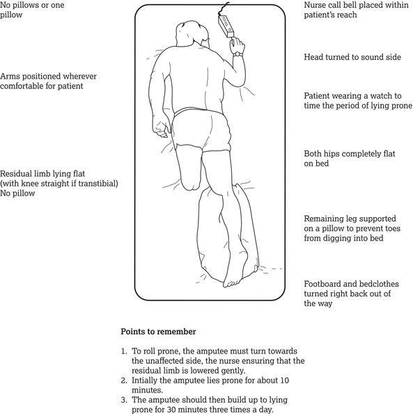 The correct position for prone lying. Source: Reproduced from Engstrom and van de Ven () with permission of Elsevier.