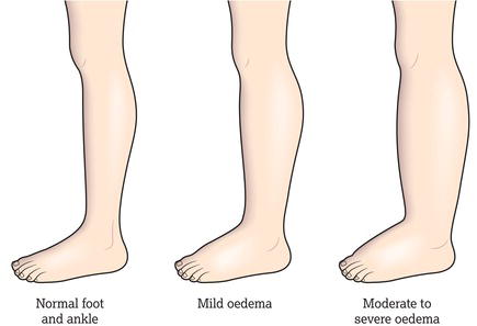 Foot and ankle oedema.