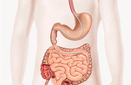 Nasojejunal tube in situ. Source: Lord ().