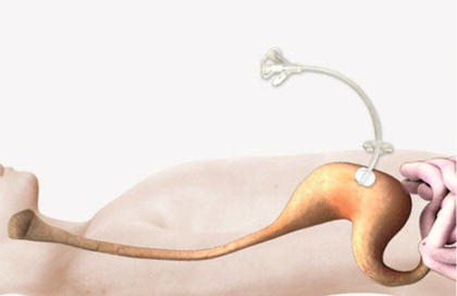 Gastrostomy tube in situ. Source: Lord ().