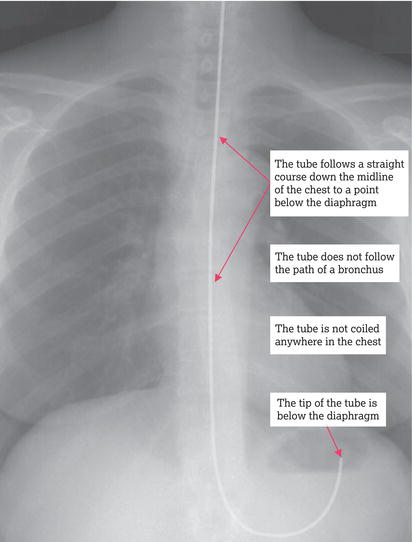 X‐radiograph of a correctly inserted nasogastric tube. Source: Reproduced from PPSA () with permission of the ECRI Institute (ecri.org.uk).