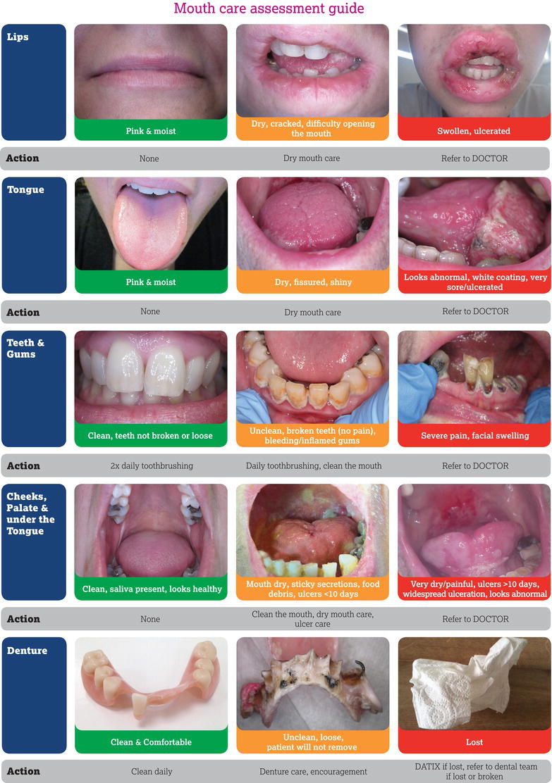 Mouth Care Assessment Guide. Source: Reproduced from HEE () with permission of the NHS. Image created and owned by Public Health England (www.mouthcar