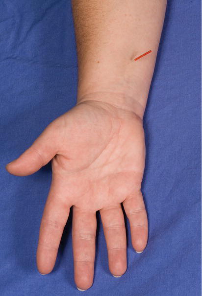 A generic acupuncture point (PC6) often used for nausea and pain.