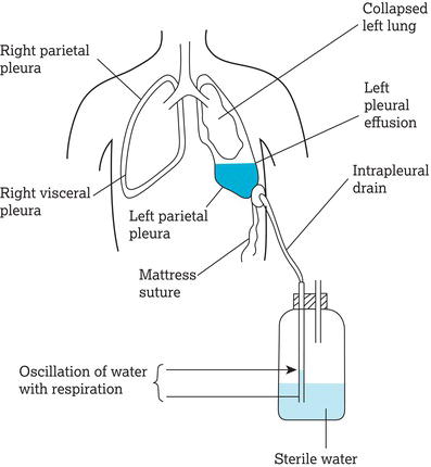 A chest drain and underwater seal bottle are used to drain a left pleural effusion.