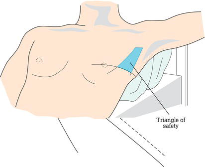 Triangle of safety. 
Source: Laws et al. (). Reproduced with permission of BMJ Publishing Group, Ltd.