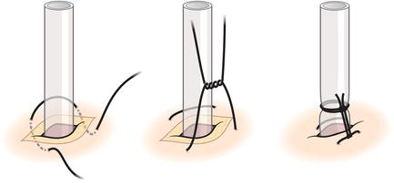 Mattress suture.