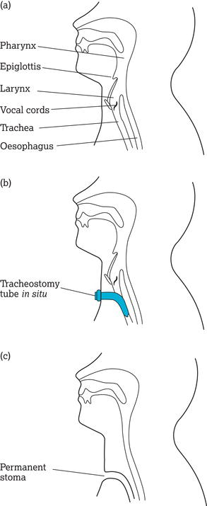 (a) Anatomy of the head and neck. (b) Tracheostomy. (c) Laryngectomy.