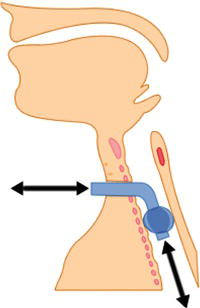 Cuffed tracheostomy tube in situ. 
Source: Reproduced with permission from the National Tracheostomy Safety Project (www.tracheostomy.org.uk).