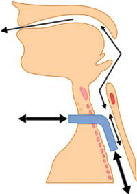 Fenestrated uncuffed tube in situ. 
Source: Reproduced with permission from the National Tracheostomy Safety Project (www.tracheostomy.org.uk).