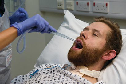 Oral suction using a Yankauer suction tip.