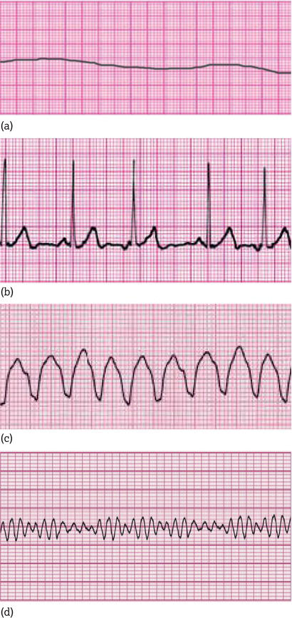 Cardiac arrest rhythms. (a) Asystole: non‐shockable. (b) Pulseless electrical activity (PEA): non‐shockable. (c) Pulseless ventricular tachycardia (VT