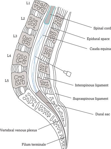 Lumbar puncture. Sagittal section through the lumbosacral spine. The most common sites for lumbar puncture are between L3 and L4 and between L4 and L5