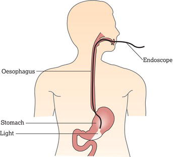 Endoscopy. Source: Reproduced with permission of the patient information website of Cancer Research UK (www.cancerresearchuk.org/cancerhelp).