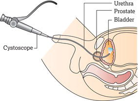 Cystoscopy for a man. Source: Reproduced with permission of the patient information website of Cancer Research UK (www.cancerresearchuk.org/cancerhelp