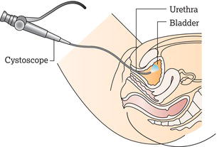 Cystoscopy for a woman. Source: Reproduced with permission of the patient information website of Cancer Research UK (www.cancerresearchuk.org/cancerhe