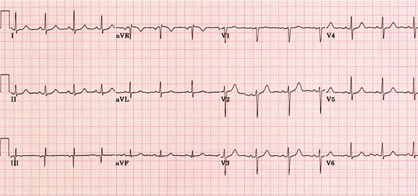 A 12‐lead electrocardiogram (ECG). Source: Reproduced from https://meds.queensu.ca/central/assets/modules/ECG/the_12_lead_ecg.html.