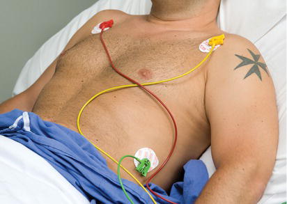 Three‐lead electrocardiogram (ECG) electrode placement.