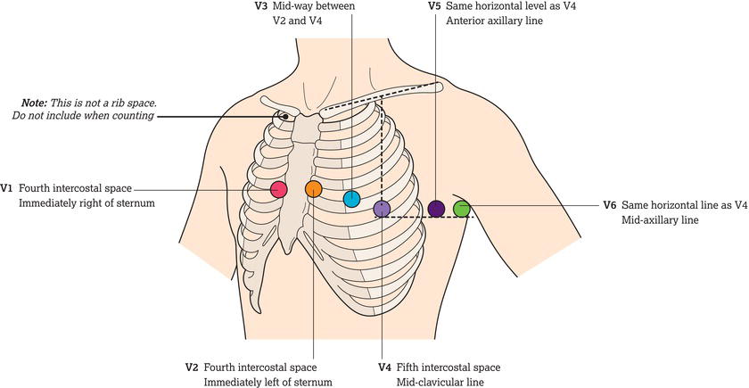 Position of chest electrodes for a 12‐lead electrocardiogram (ECG). Source: SCST () – The Society for Cardiological Science and Technology (www.scst.o