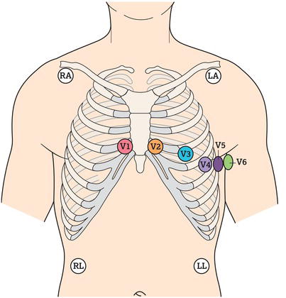 Mason–Likar 12‐lead electrocardiogram (ECG) system.