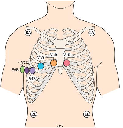 Right‐sided chest lead positioning for an electrocardiogram (ECG).