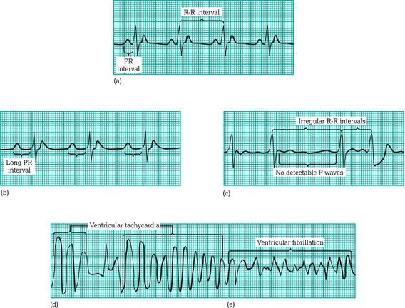 (a) Normal electrocardiogram tracing. Abnormal electrocardiogram tracings: (b) first‐degree AV block, (c) atrial fibrillation, (d) ventricular tachyca