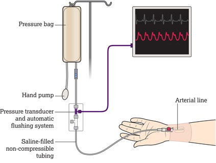 Arterial line and transducer set.