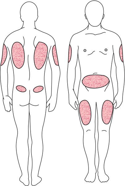 Sites recommended for subcutaneous injection. Source: Adapted from Perry et al. () with permission of Elsevier.