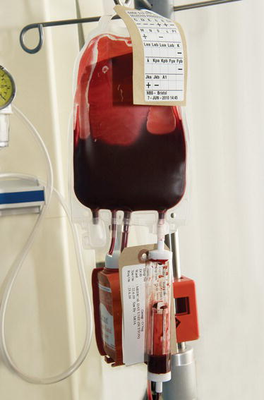 Blood administration set.