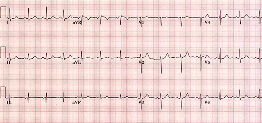 An example of a 12‐lead electrocardiogram (ECG).