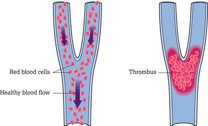 Pulmonary embolism.