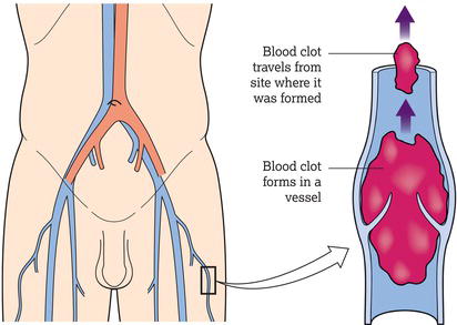 Deep vein thrombosis.